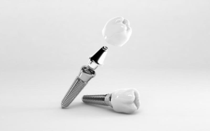 Which Country Is the Best for Dental Implants Why Albania 